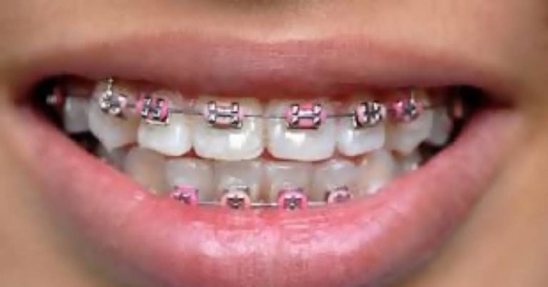 箍牙治療的副作用